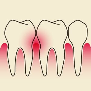 periodontal disease schaumburg 